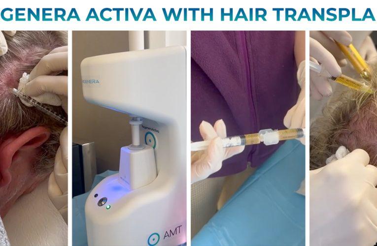 Newly hair transplant method: Studies says hair transplant with Regenera Activa provides successful and permanent result